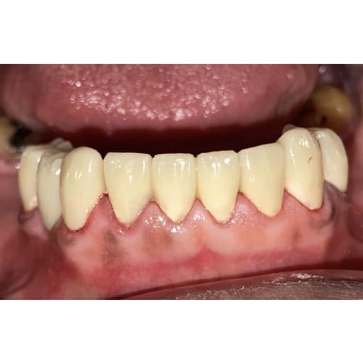 After photo of Porcelain Crowns  - 