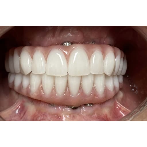 After photo of Full Mouth Implant Rehabilitation  - 