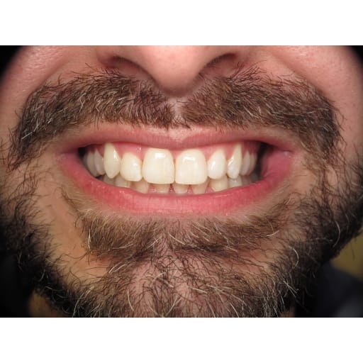 After photo of Invisalign Patient - Invisalign