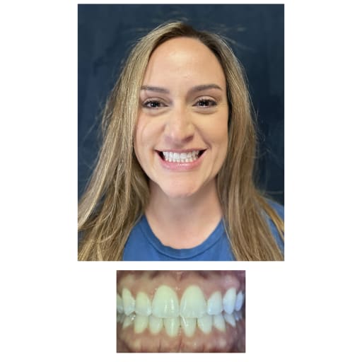 After photo of Invisalign Patient - Invisalign Patient