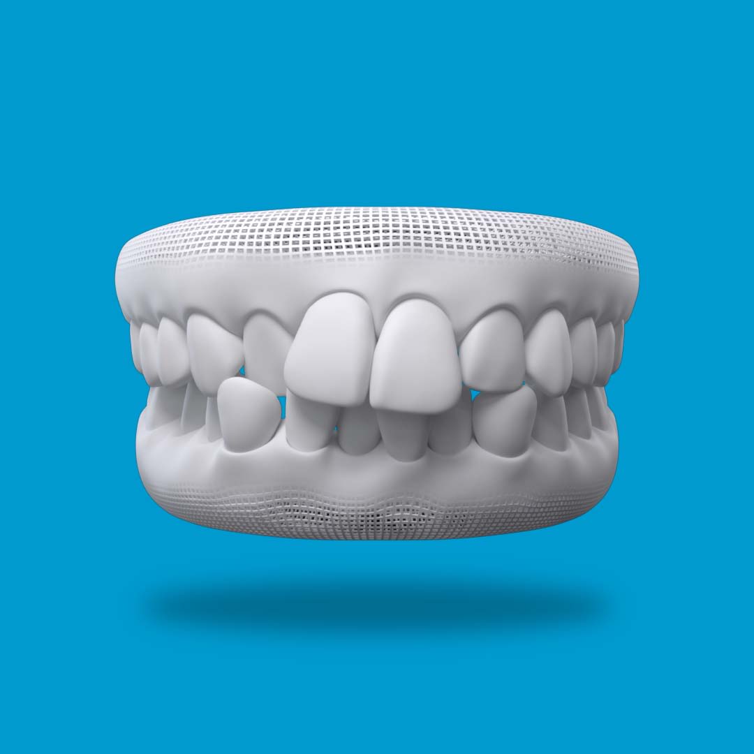 Misaligned/Crooked Teeth