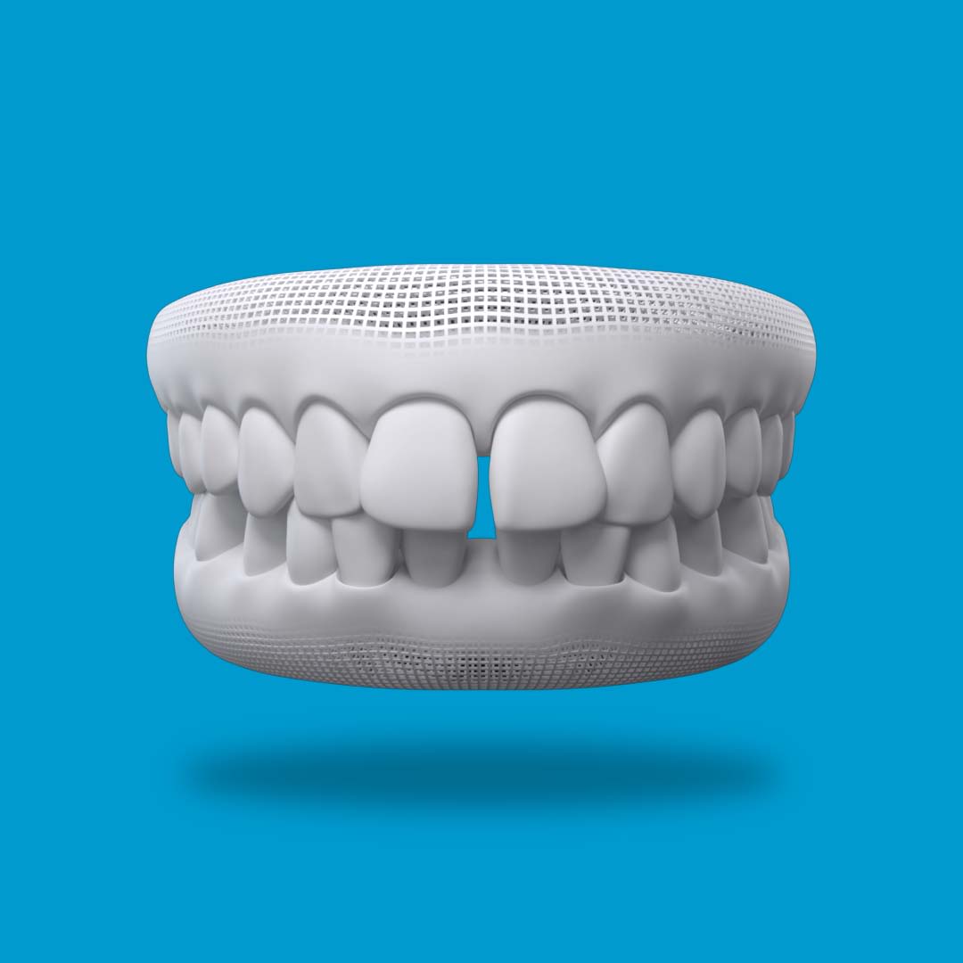 invisalign gap in front teeth