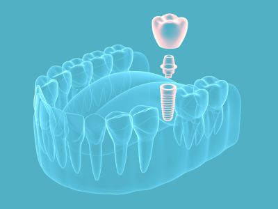 Diagram showing a single implant placement