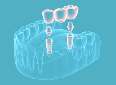 Diagram showing a multi-implant bridge