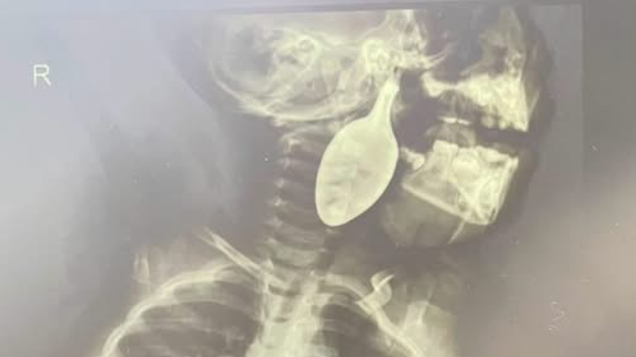 Imagem raio x tirada por equipes médicas no procedimento cirúrgico