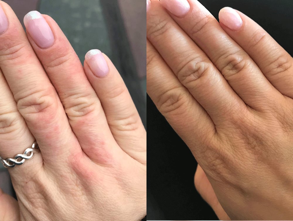 Eczema - before after
