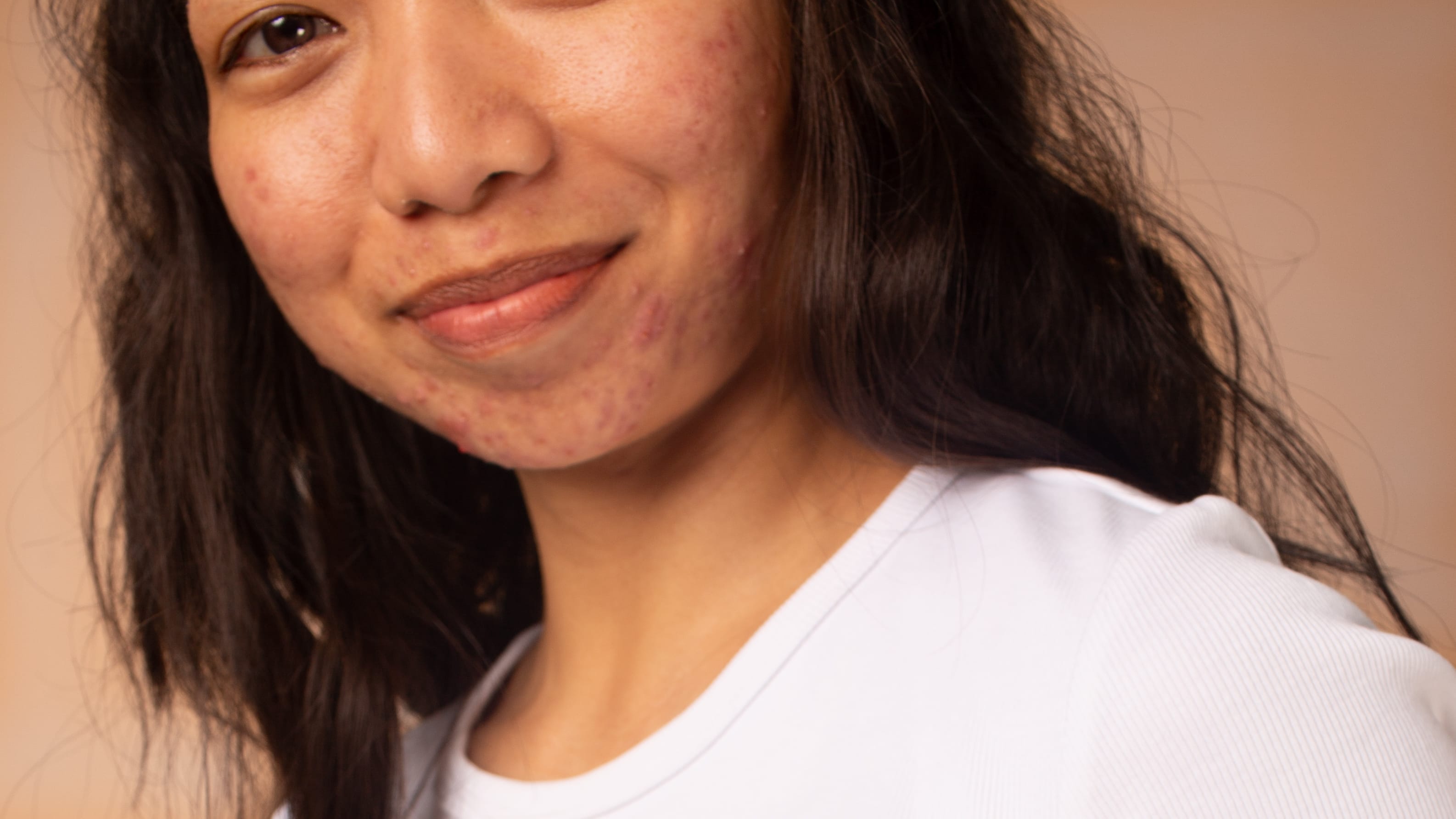 What does acne look like - picture of acne