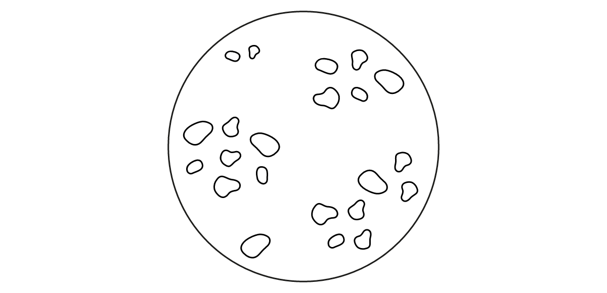 What does hyperpigmentation look like? 