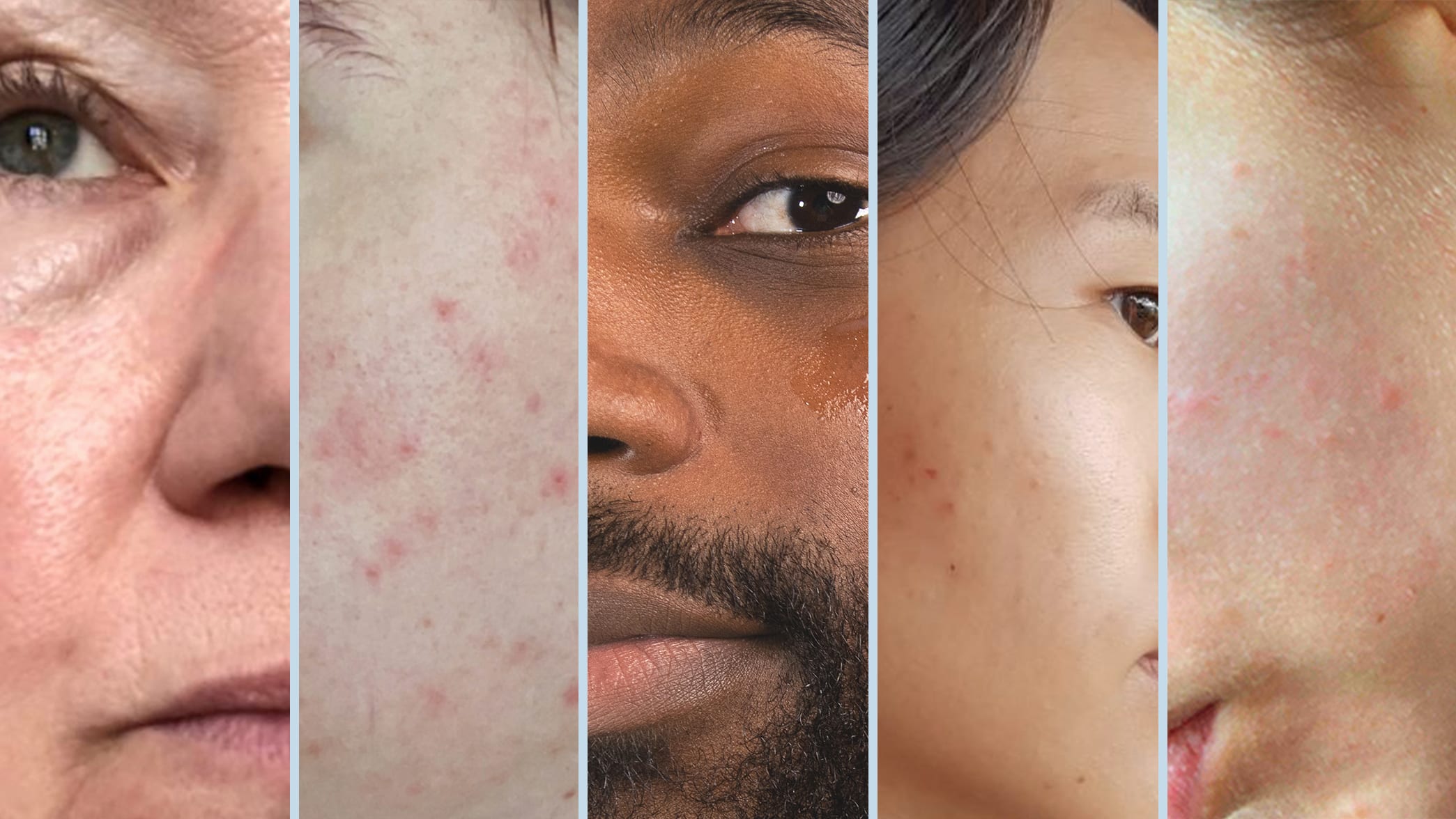 5-different-skin-types