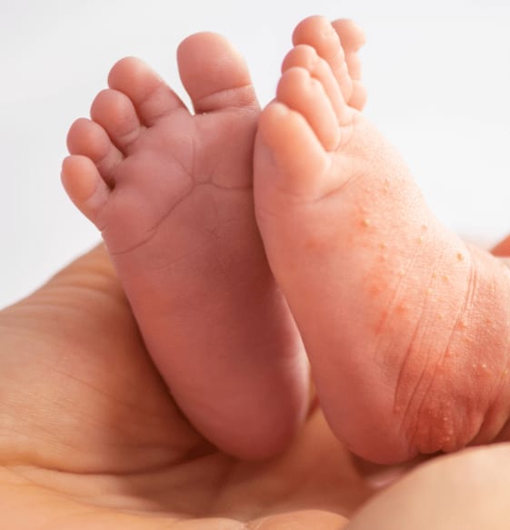 Suave Santuario Factibilidad Dermatitis atópica en bebés 👶 Hero Baby