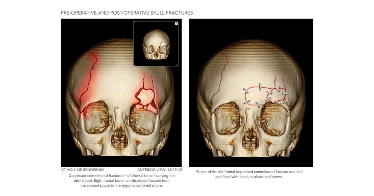 skull fracture long term effects