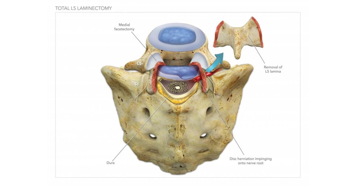 laminectomy