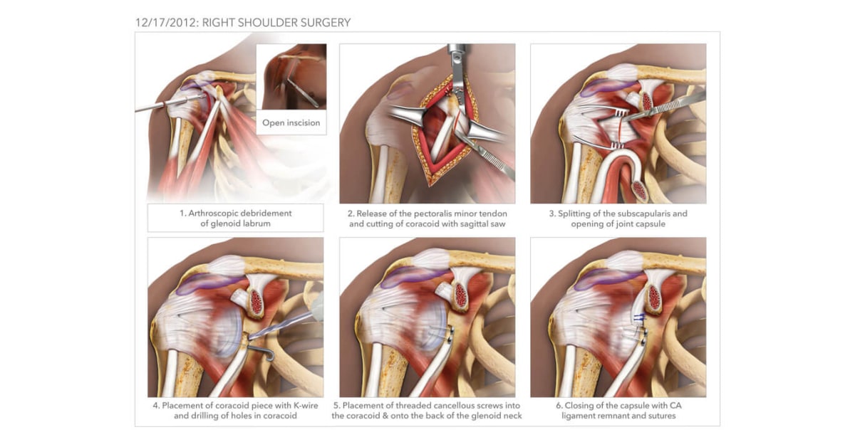 Shoulder Surgery High Impact® Visual Litigation Strategies™