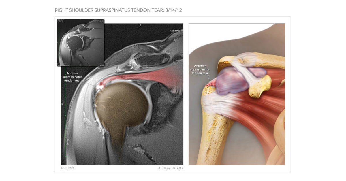 Anterior Supraspinatus Tendon Tear High Impact Visual Litigation Strategies