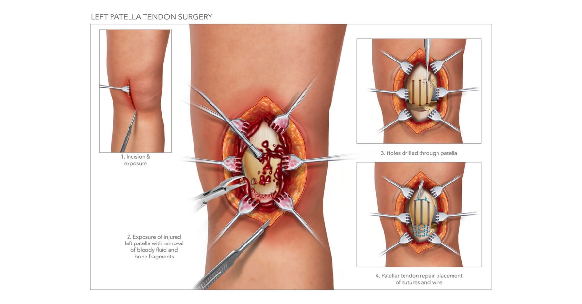 left patella