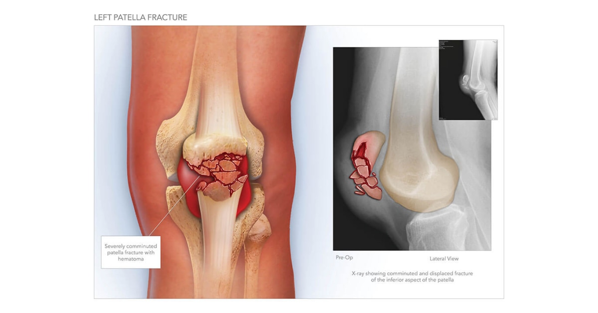 left patella