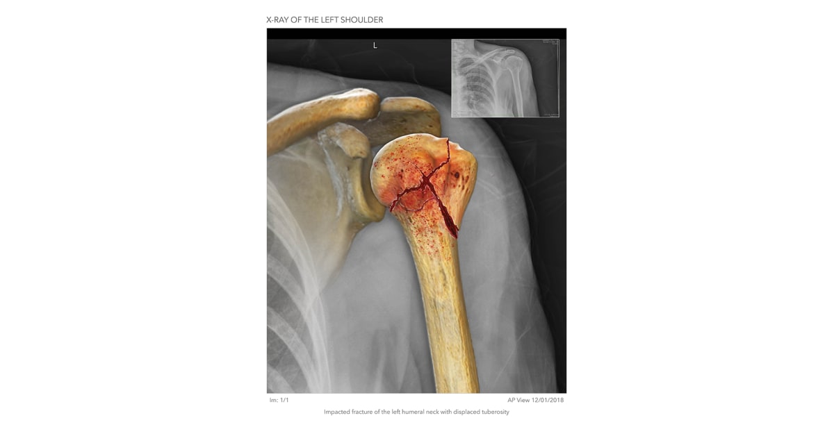 humeral neck fracture