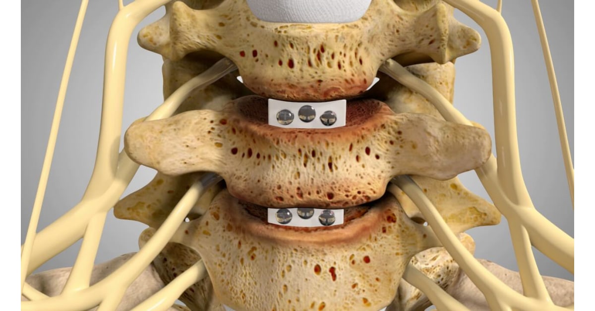 Cervical Disc Replacement Vs Fusion