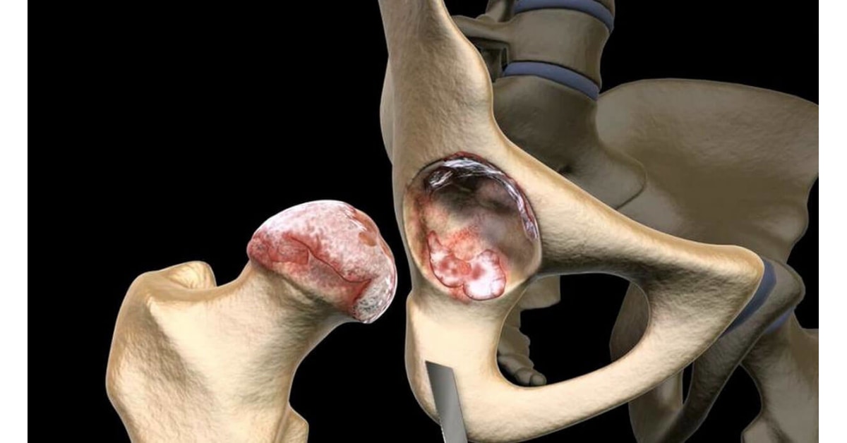 Total Hip Replacement High Impact® Visual Litigation