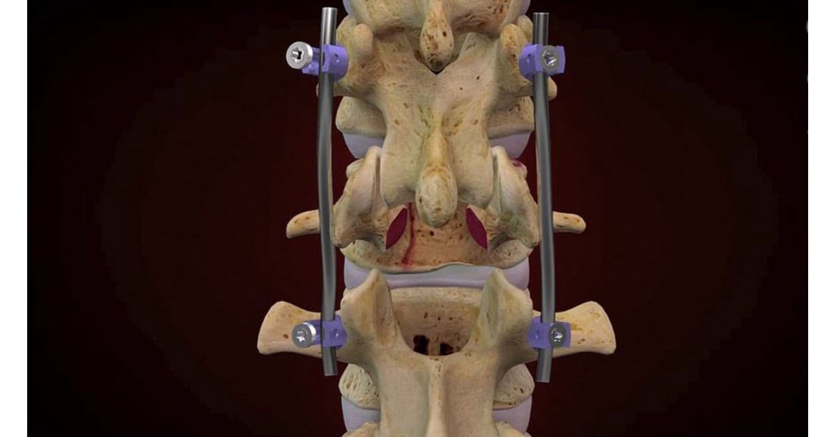 burst fracture burst fracture
