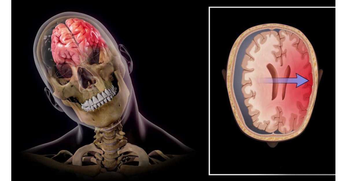 Closed head injury case study 71 07 image