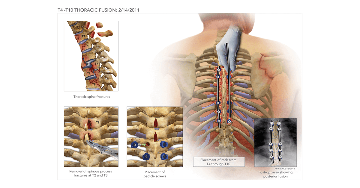 T4 T10 Thoracic Fusion High Impact Visual Litigation Strategies