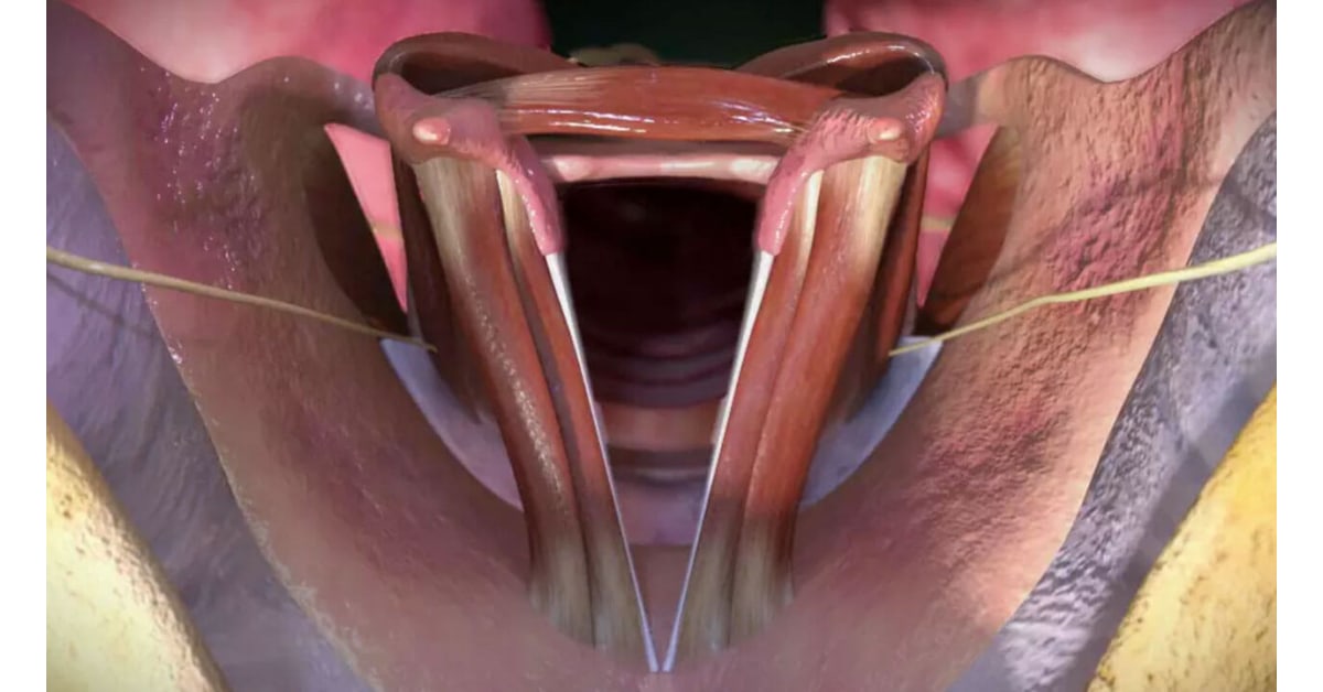Laryngeal Muscles | High Impact® Visual Litigation Strategies™