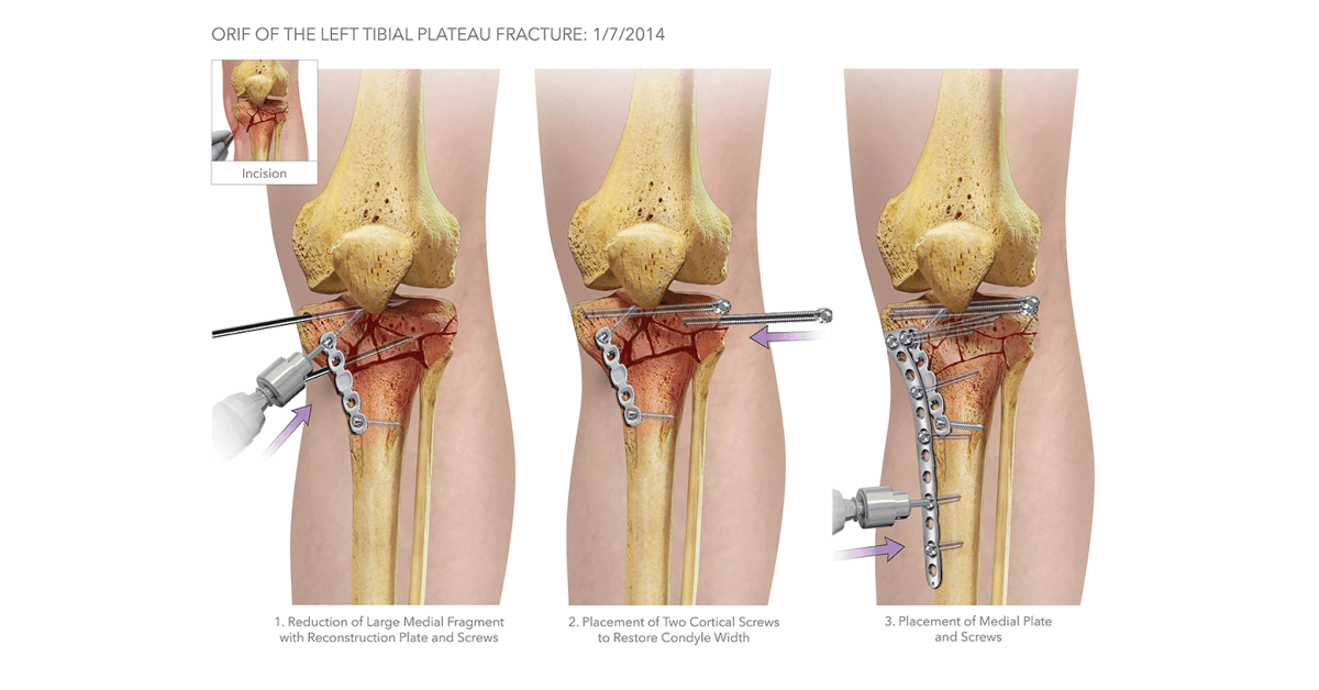 Open Reduction Internal Fixation of the Tibial Plateau.