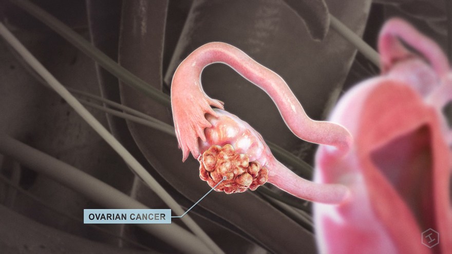 How Talcum Powder Contaminated With Asbestos Causes Cancer ...
