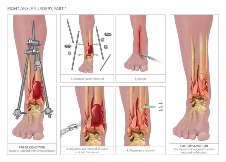 ankle surgery open reduction internal fixation