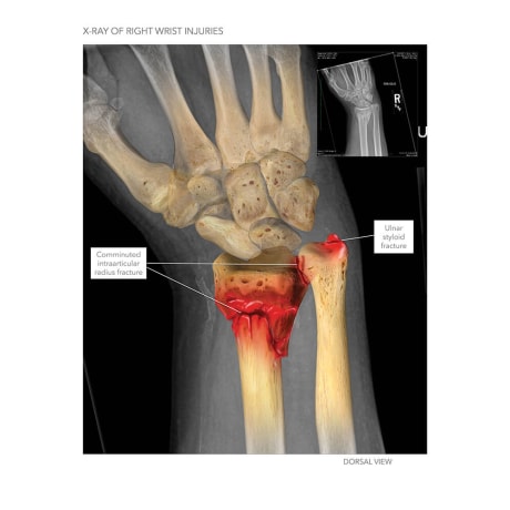 Wrist Injuries and Surgery | High Impact® Visual Litigation Strategies™