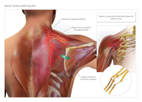 right rotator cuff injury