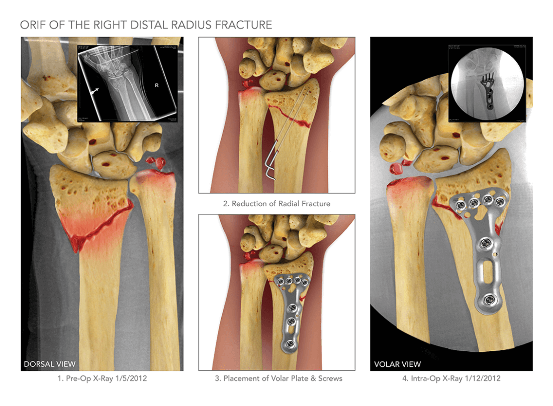 Orif Of Right Distal Radius Fracture High Impact Visual