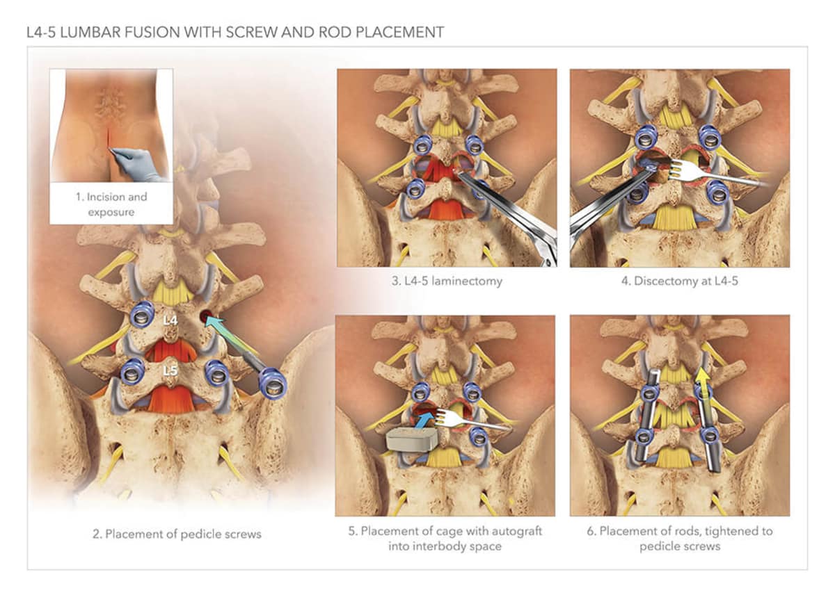 L4 5 Lumbar Fusion With Screw And Rod Placement High Impact