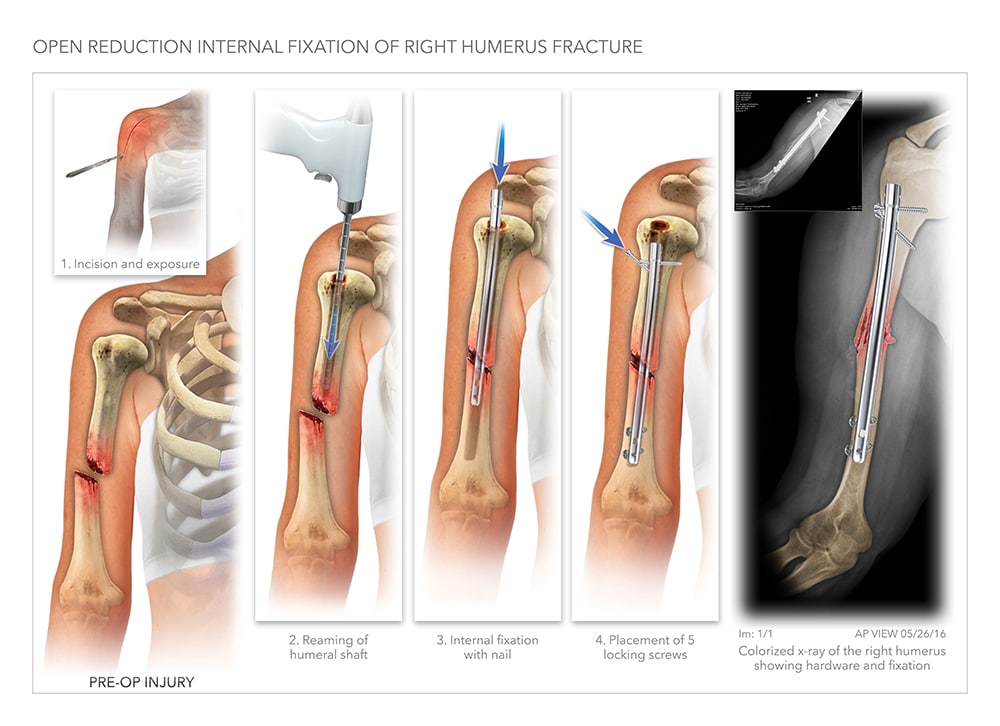 Humeral Shaft Fractures Open Reduction Internal Fixation Teachme My