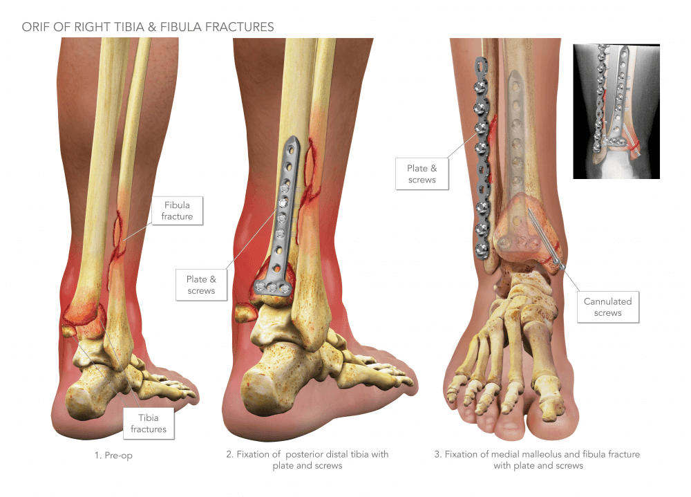 tibia and fibula fracture