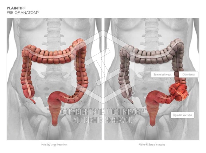 225k Verdict Illustrating Twisted Colon Malpractice High Impact Visual Litigation Strategies
