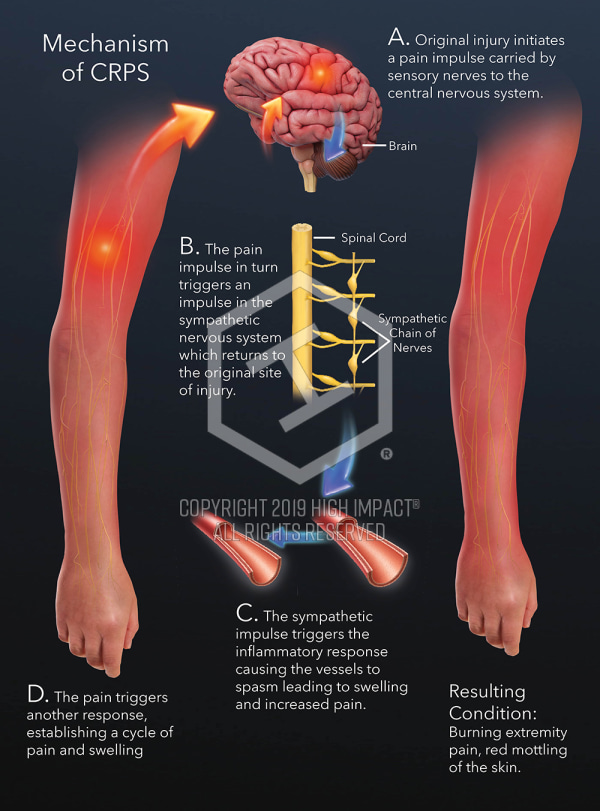 $16M Verdict Illustrating How Electrical Injury Caused CRPS After