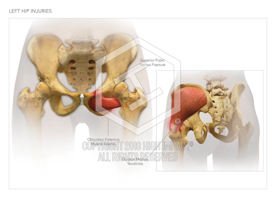 Left Hip Injuries | High Impact® Visual Litigation Strategies™