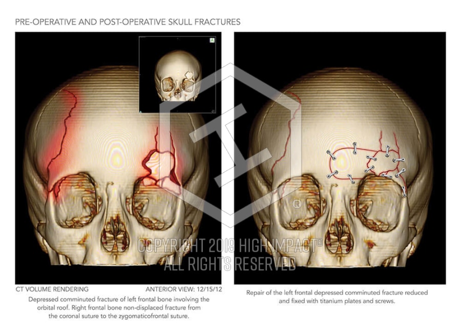 skull fracture long term effects