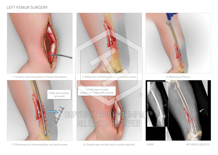 Left Femur Intramedullary Nailing | High Impact® Visual Litigation