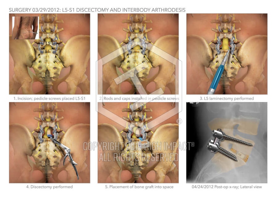 L5-S1 Discectomy and Arthrodesis | High Impact® Visual Litigation