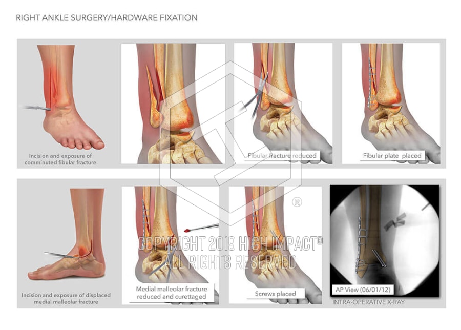 ankle surgery open reduction internal fixation