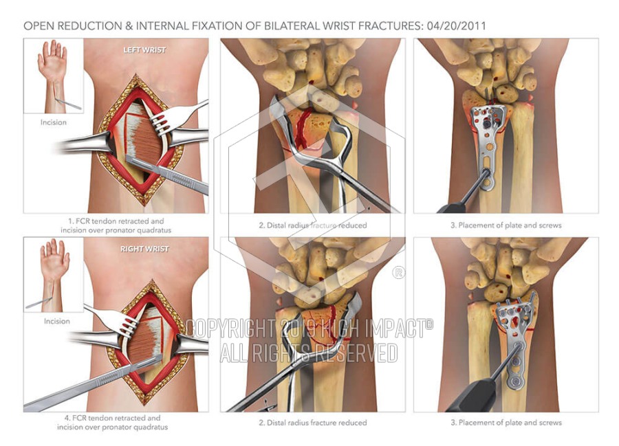 Open Reduction Internal Fixation Of Bilateral Wrist Fractures High Impact Visual Litigation Strategies