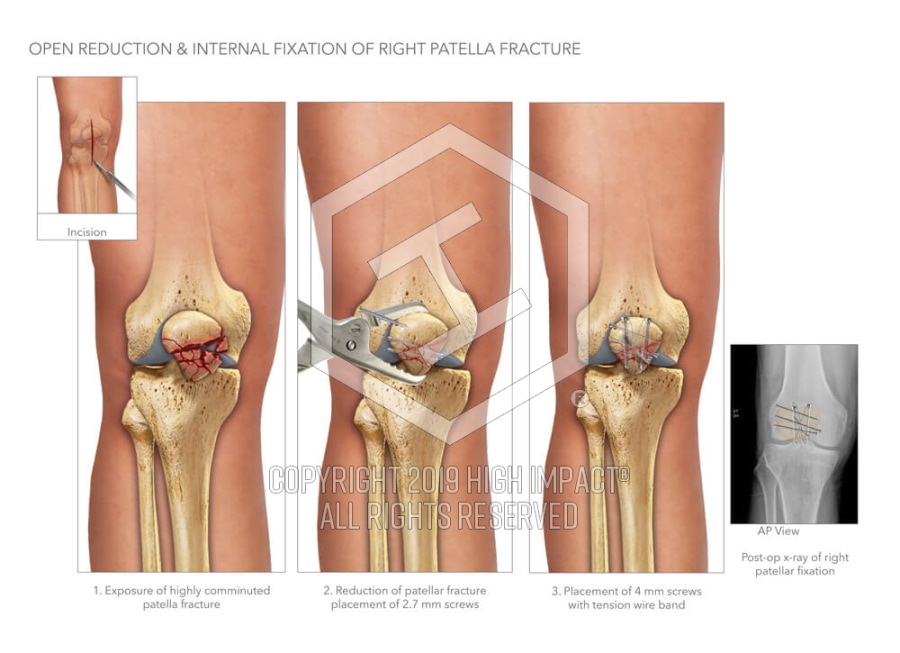 right patella