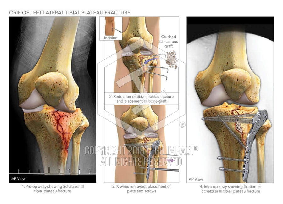 Orif Of Left Lateral Tibial Plateau Fracture High Impact