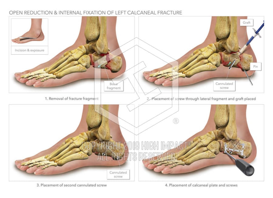 Open Reduction & Internal Fixation of Left Calcaneal ...