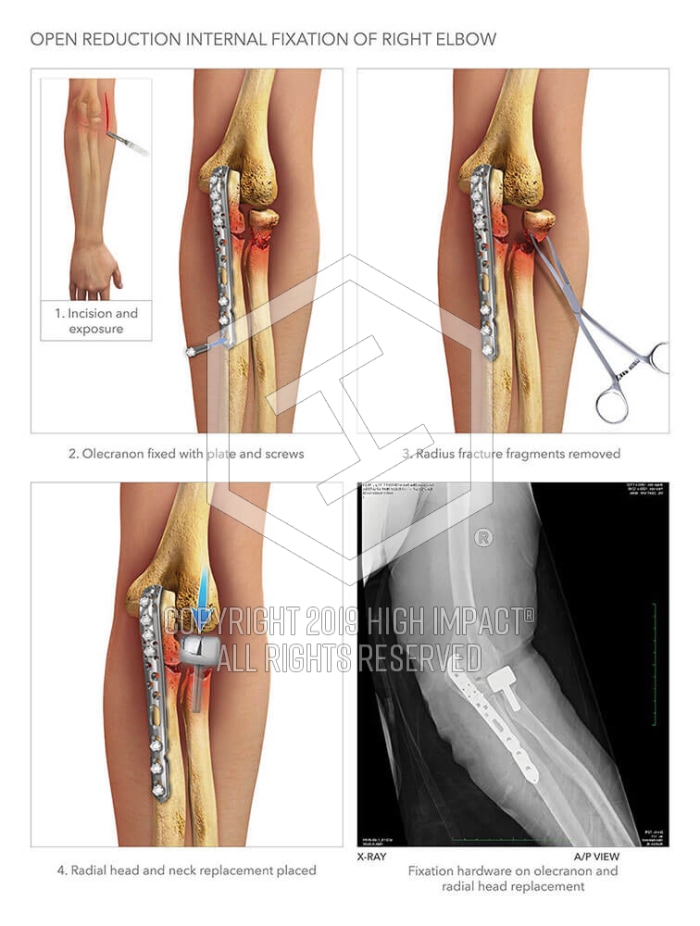 Open Reduction Internal Fixation Of Right Elbow High Impact