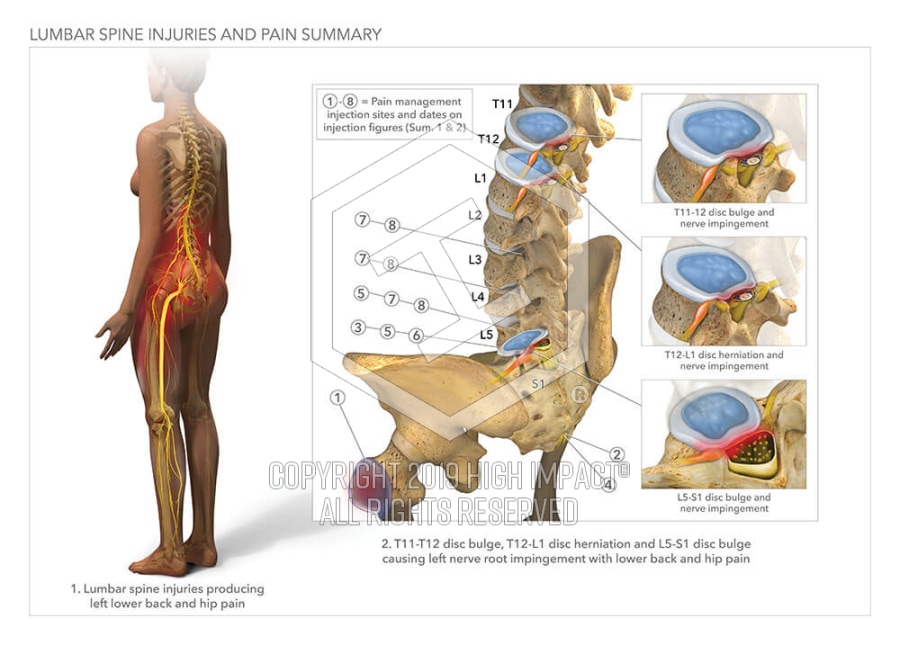 Lumbar Spine Injuries And Pain Summary High Impact Visual Litigation Strategies