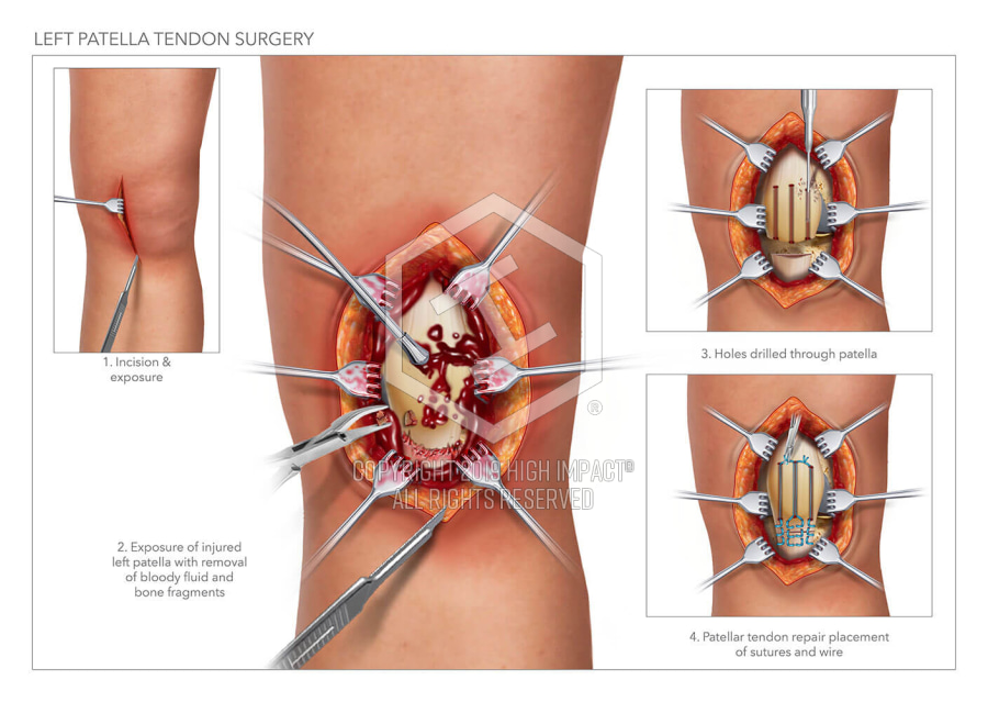 Patella Surgery Cheap Sale, 49% Off | Www.cartenztactical.com